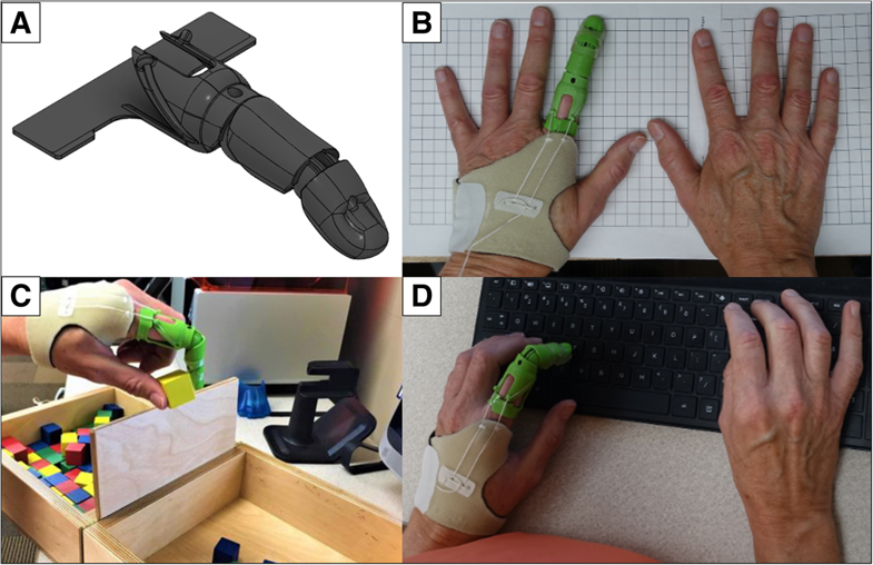 為患者3D打印特異性部分手指假體